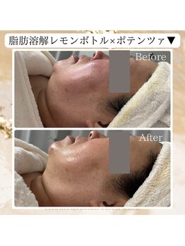 ビヌ(Binu)/脂肪分解レモンボトル・小顔ケア