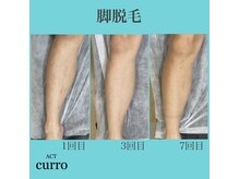 アクト クロ(ACT curro)/【脚全体】脱毛施術例