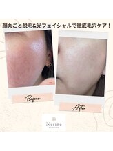 ネリネ(Nerine)/徹底毛穴レスフェイシャル