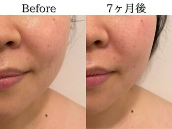 ポポラス(POPOLUS)/小顔コース7ヶ月