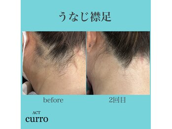 アクト クロ(ACT curro)/【うなじ襟足】脱毛施術例
