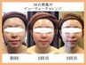 【9月限定】たるみ引き締め/シワ改善/毛穴の悩みを根本的に改善します！