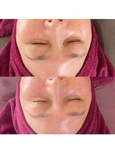 サロン アイプラス(salon i plus)/しわ/たるみ