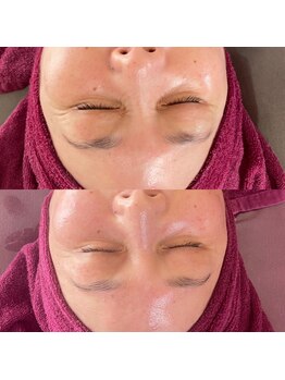 サロン アイプラス(salon i plus)/しわ/たるみ