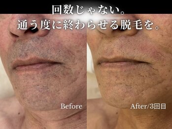 ダイヤ 名古屋中川区店(Daiya)/メンズ脱毛/ヒゲ【BeforeAfter】
