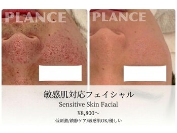 プランス 恵比寿店(PLANCE)/恵比寿　エステ　肌質改善