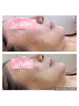 エステテックサロンラレーヌ 小山店(La Reine)/顎のたるみが気になる方も