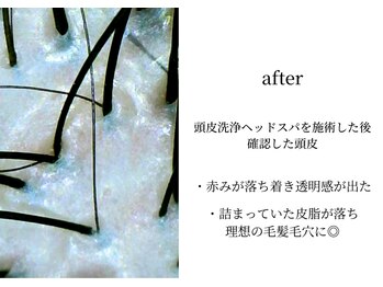 オンビューティーバイコンベックス(On Beauty by convex)/〈アフター〉キレイになった頭皮