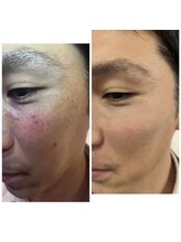 サロン ド ミコラ(salon de Micora)/【リアルな肌変化】プラズマ