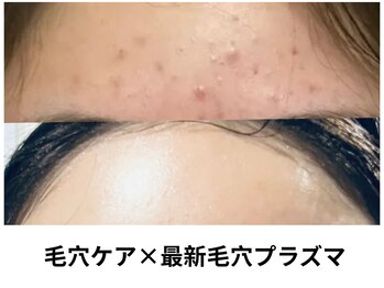 ビューティーサロン リリー(Lily)/毛穴洗浄×最新毛穴プラズマ