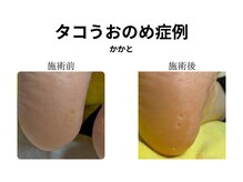 ドクターネイル爪革命 和歌山/胼胝魚の目