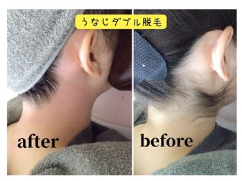 ジョエルワックス 沖縄コザ店(JOELLE WAX)/うなじダブル脱毛