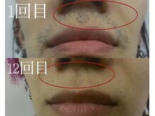 マドンナリリー 恵比寿店(Madonna Lily)/メンズ　髭脱毛