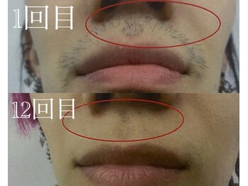 マドンナリリー 恵比寿店(Madonna Lily)/メンズ　髭脱毛