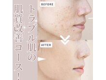 ミャオ(Meow!)の雰囲気（肌荒れ/敏感肌/ニキビケア/ピーリング/赤み/乾燥/肌トラブル改善）