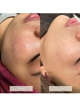 タグ 高知駅前店(Tug)/ニキビケア/跡/毛穴開き