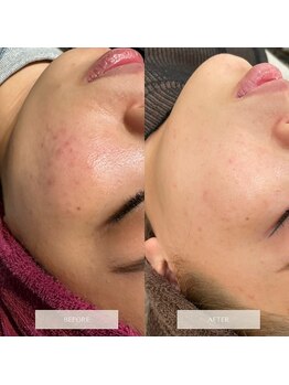 タグ 高知駅前店(Tug)/ニキビケア/跡/毛穴開き