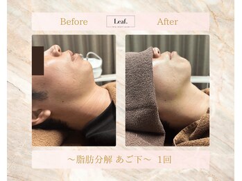 リーフ(Leaf.)/脂肪分解　あご下