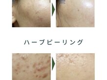 ミアボーテ(MIA BEAUTE)の雰囲気（人気のハーブピーリングで肌質改善♪剥離なし！）