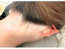 アム(aM)/むくみ・フェイスライン美容鍼