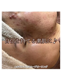 サロンドオフ 西梅田(salon de off)/ニキビケアのビフォーアフター*