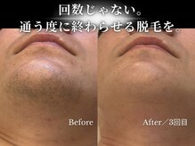 ダイヤ 名古屋中川区店(Daiya)/メンズ脱毛/ヒゲ【BeforeAfter】