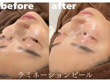 ホワイトラボ 堺東(White labo)/【30代女性 施術1回の効果】