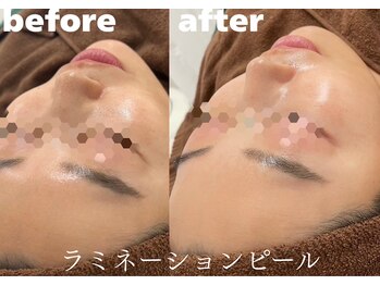 ホワイトラボ 堺東(White labo)/【30代女性 施術1回の効果】