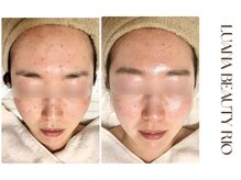 リオ(RIO)/繰り返す肌荒れも◎