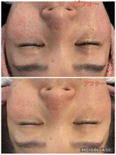 サロンドラニ(salon de LANI)/【プラズマフェイシャル】症例