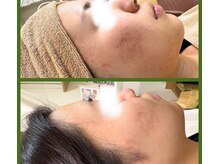 モモンウールーの雰囲気（20代ニキビ1回の施術効果）