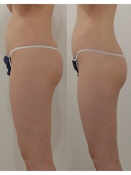 クレール アオヤマ(CLAIRE AOYAMA)/【40日】細身の方もさらに細く！