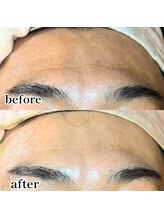 アノネ(Anone.)/プラズマ×ハーブピーリング