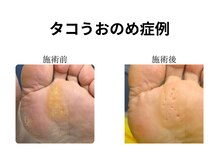 ドクターネイル爪革命 和歌山/胼胝魚の目