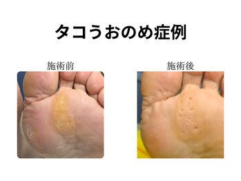 ドクターネイル爪革命 和歌山/胼胝魚の目