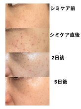 シフォン(Chiffon)/シミケア後の経過