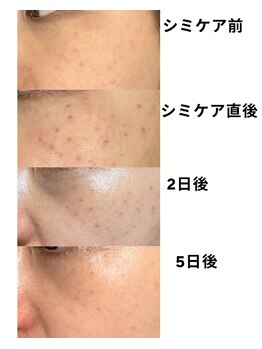 シフォン(Chiffon)/シミケア後の経過