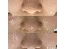 プラセル(Placer)の雰囲気（きれいになるのはもちろん♪悩みを繰り返さない健康な肌へ！！）