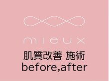 ミュー 多治見店(mieux)/肌質改善 before,after