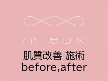 ミュー 多治見店(mieux)/肌質改善 before,after