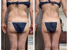 フュース(Futh)/セルライトケア全身12回/49歳