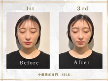 シルク(SILK)の雰囲気（Point 1 「小顔・顔の悩み専門」エラ張り・たるみ・左右差に特化）