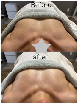 ベッピン(Beppin)/バストケア/筋膜リリース静岡