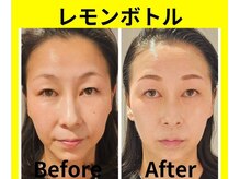 アン 銀座(ann)/レモンボトル&エクソソーム