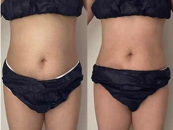 キララ(Kirara)/2ヶ月でこのお腹の変化★