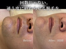 ダイヤ 名古屋中川区店(Daiya)/メンズ脱毛/ヒゲ【BeforeAfter】