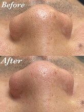 コリー(Kolly)/毛穴洗浄