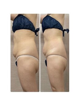 ソフィア わさだ店/30代セルゼロ半身コース12回