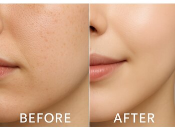 ファロンビューティー(fallon beauty)/フェイシャルエイン毛穴ケア