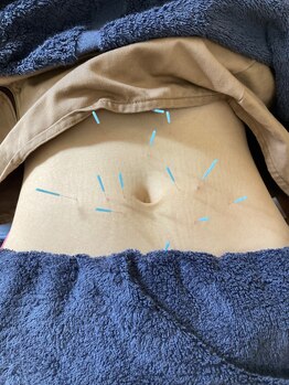 テイクケア(TAKEケア)/腸鍼